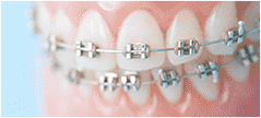 歯の表面に金属を装着する従来からの一般的な治療